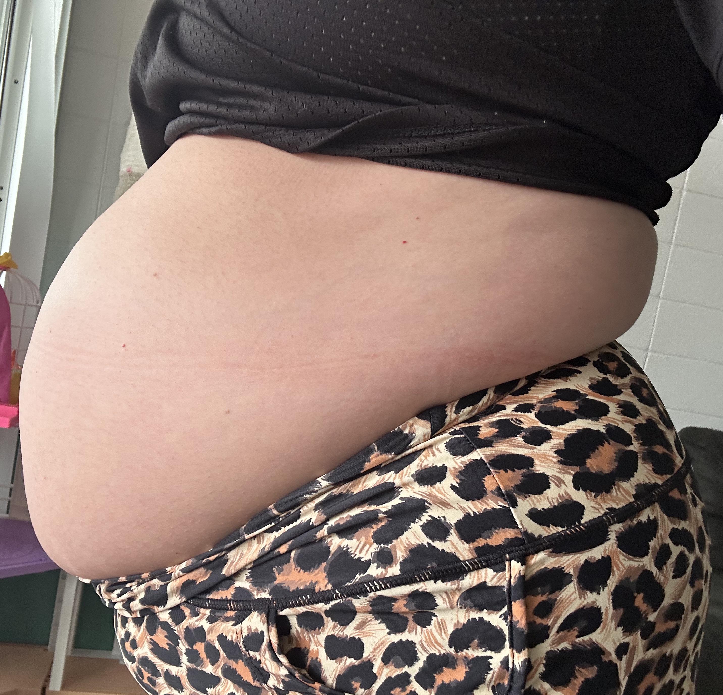 Sichtbarer Blähbauch und aufgetriebener Unterleib